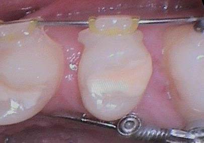 Zahnbewegung nach hinten durch Fixpunkt Miniimplantat